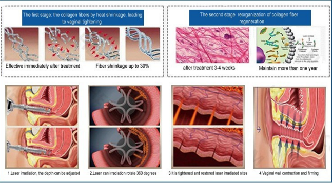 Resurfacing Fractional Acne Scar Removal Machine , CO2 Laser Resurfacing Machine 4