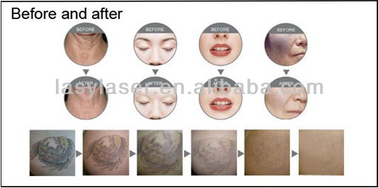 Macchina di depilazione laser multifunzionale per la cura della pelle SHR Elight IPL 5