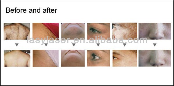 Macchina di depilazione laser multifunzionale per la cura della pelle SHR Elight IPL 4