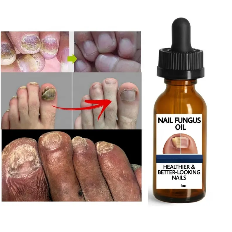 Индивидуальное масло для грибка ногтей красивый здоровый уход за ногтями лечебная Сыворотка от грибков для рук и ног восстанавливающий гель