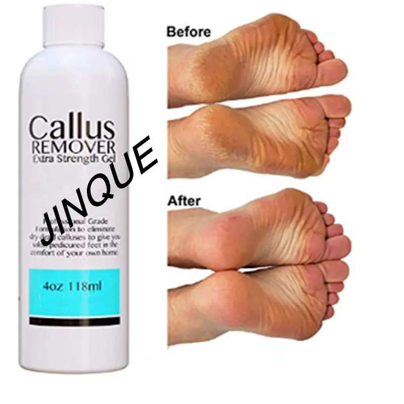 Best foot Callus Remover gel, Callus Eliminator, Liquid & Gel For Corn And Callus On Feet