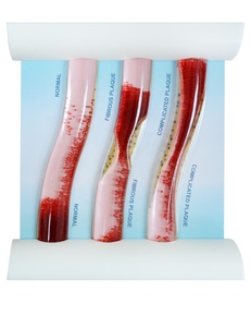 Modelo de trombosis dinámica: Demostración de patología de enfermedades vasculares con simulación de vasos sanguíneos LDL para Educación Médica - Product Image 1