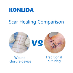 Khẩn cấp vết thương đóng cửa thiết bị khâu miễn phí cho phẫu thuật điều trị rách - Product Image 2