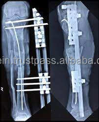 מתקן מסילה LRS שיקום איבר אורך איבר מתקן חיצוני דחיסה עצם סיבוב טראומה שתל אורטופדי - Product Image 5