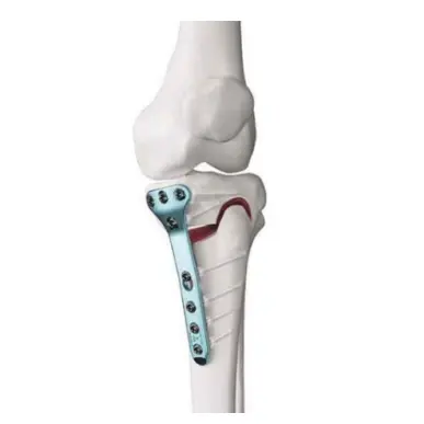 Alicates de placa de flexión de hueso ortopédico con mango largo de acero inoxidable de calidad superior médico a instrumentos quirúrgicos
