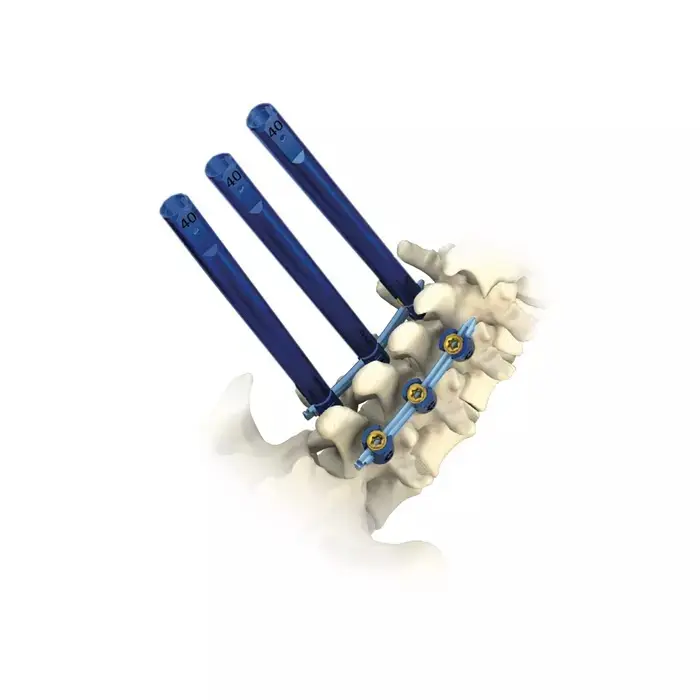 Canwell Medical Lumbar Spinal Set Titanium Pedicle Screw Probe Manual Steel Stainless Implants with CE Quality Certification
