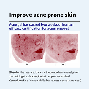 Gel trị mụn nhanh chóng và hiệu quả Chiết xuất thực vật tự nhiên Loại bỏ mụn trứng cá một cách hiệu quả Cải thiện tình trạng thu nhỏ lỗ chân lông Kem dưỡng da mặt - Product Image 6