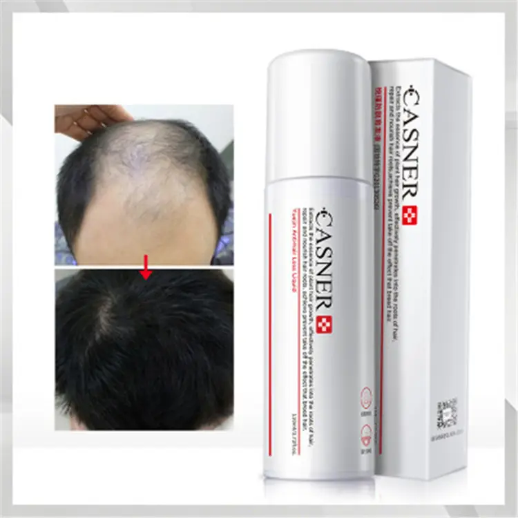 CASNER pelo Calvo tratamientos de Alopecia cura ayuda el crecimiento del cabello sano suero para hombres y mujeres con familia de uso diario