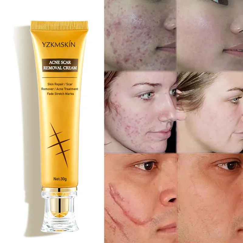 Creme reparador de cicatriz personalizado, atacado, creme removedor de acne para manchas escuras faciais, remoção de acne e cicatrizes