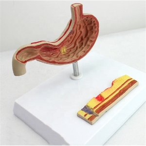 Factory PVC Anatomical Model for Gastric Pathology Perforation and Ulcer Section Enhanced Communication Reduction <strong>Explanation</strong> - Product Image 3
