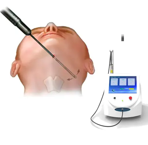 Máquina de liposucción de cánulas de 60W, máquina láser endoláser, lipólisis láser con 980nm, eliminación de arañas vasculares, hongos, láser de uñas