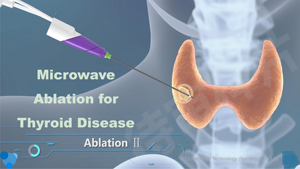 Intervention Radiology Department Microwave Ablation System for Thyroid <strong>Nodule</strong> Ablation