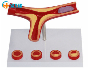 <strong>Human</strong> Blood Vessel Magnification Model Thrombus Model Blood Vessel Model - Product Image 2