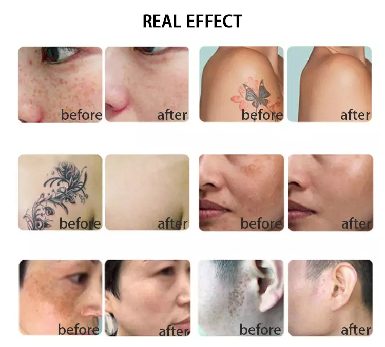 picosure picosecond pigment removal