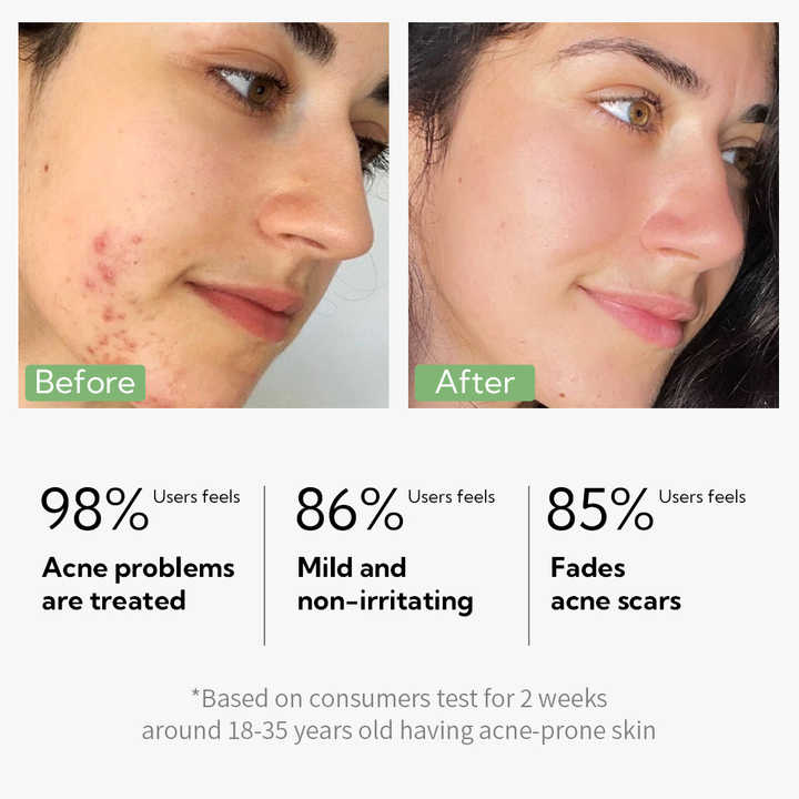 LANBENA Skin Care Anti Acne Serum with 5% Niacinamide + 2% Salicylic Acid Serum for Skin Repairing Clears Improves Marks