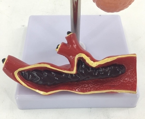 Medical Science <strong>Human</strong> Pathology Model Hypertension Anatomical Model High Blood Pressure Model - Product Image 3