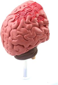 KyrenMed İnsan beyin patolojik Model malforme beyin hastalıklı yapı beyin epilepsi inme serebral vasküler hastalık modeli - Product Image 6