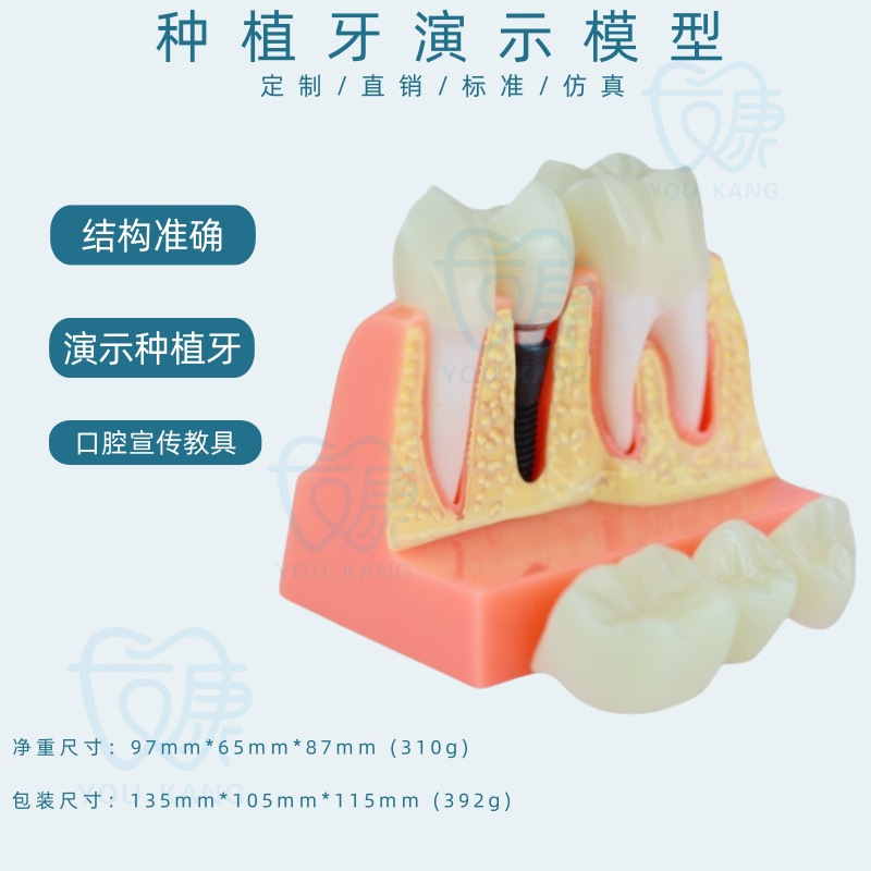 Implant dentaire B, fond jaune, clou noir.