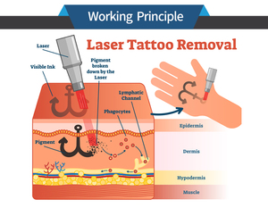 Q Switched ND Yag laser Loại bỏ hình xăm Máy 2023 Q chuyển đổi Yag laser Neodymium Nd Yag Loại bỏ hình xăm - Product Image 6