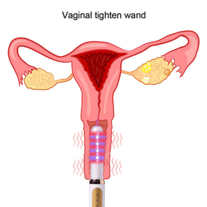 Soulagement ciblé de l'incontinence urinaire - Appareil laser froid pour le resserrement vaginal, soulagement de la vaginite, rechargeable par USB - Product Image 3
