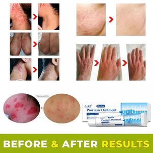 Hot Sale Factory Fast Shipping Powerful Moisturizing Psoriasis Cream Herbal Eczema <strong>Ointment</strong> for Adult Dermatitis Skin Problem