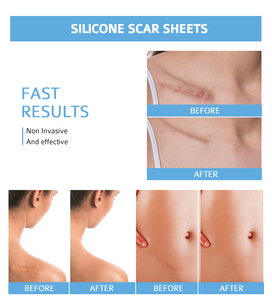 เทปพันแผลซิลิโคนรักษารอยแผลเป็น - Product Image 6