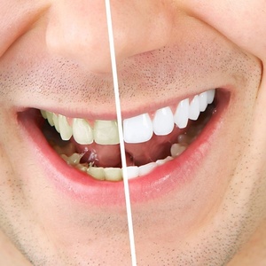 3Ml Nha Khoa Răng Miệng Răng Làm Trắng Bút Răng Gel Làm Trắng Hệ Thống Tẩy Vết Bẩn Thuốc Lá Tẩy Khói Loại Bỏ Ngay Lập Tức - Product Image 3