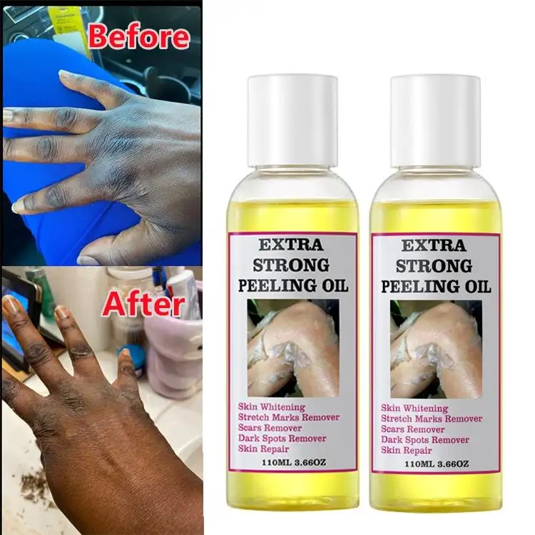 Extra Strong Peeling Oil Scar Remove Stretch Marks Exfoliating Peeling Solution Whitening Yellow Peeling Oil