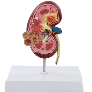 Medical Teaching Urinary System Model Human Anatomy Kidney Model Kidney Diseased Model