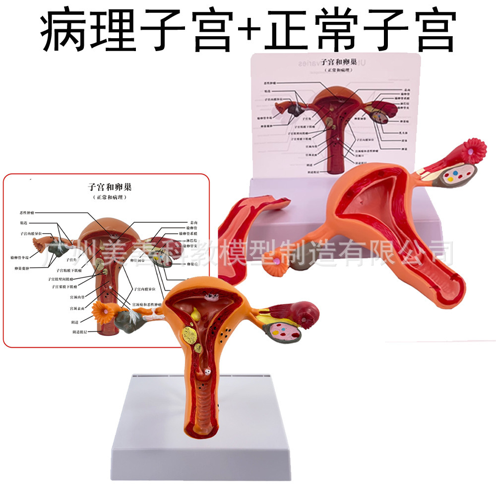Utérus pathologique avec revêtement utérin, utérus normal