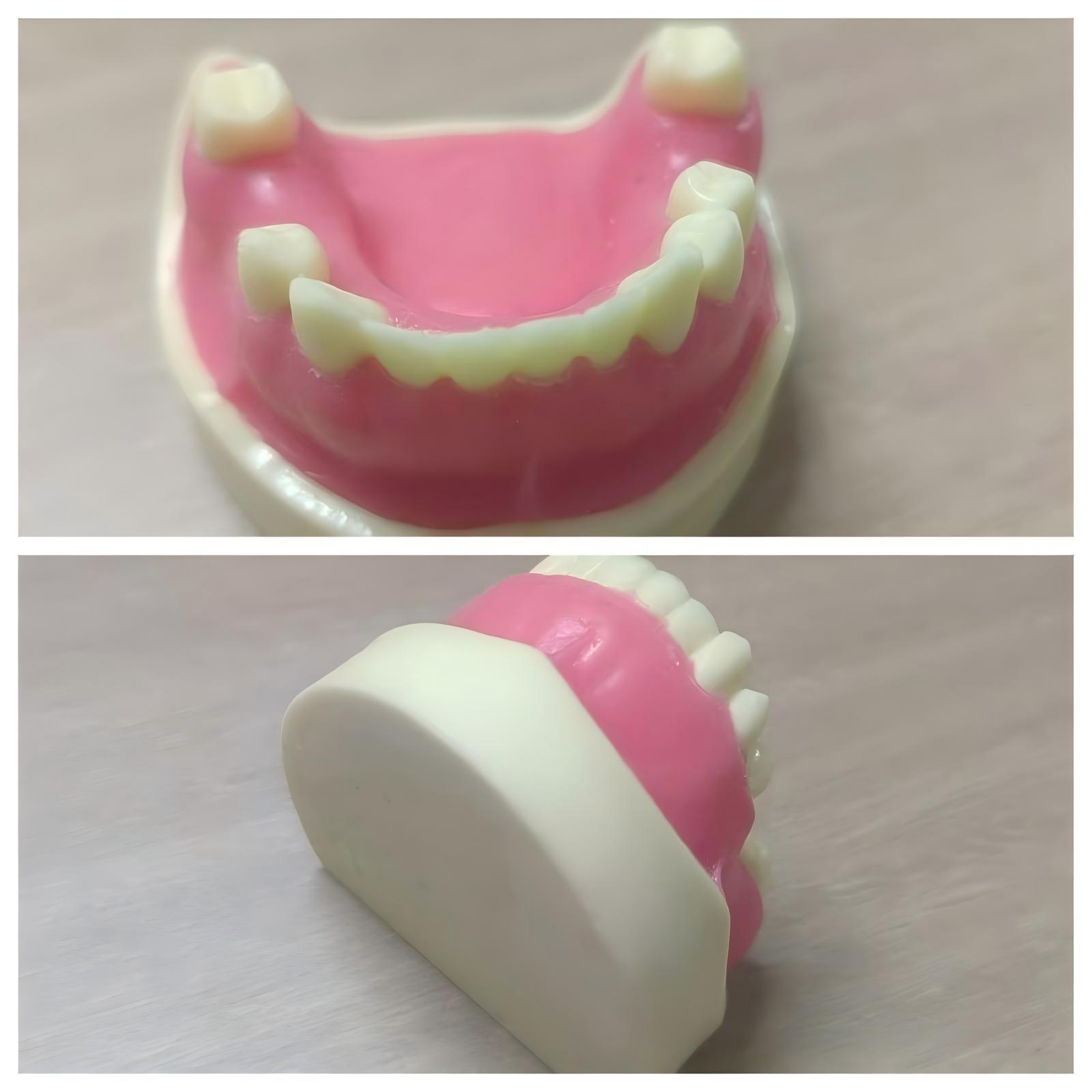 Blanco Nuevo Implante Mandibular Faltan 3 Dientes