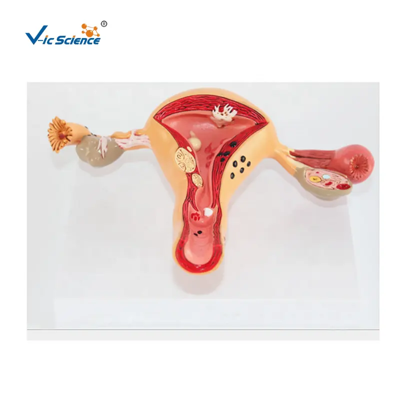 Медицинская анатомическая модель медицинская научная Женская репродуктивная система патология анатомическая модель медицинская научная образовательная модель