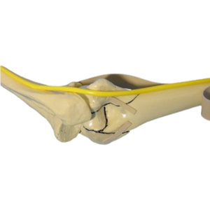 KyrenMed Coude droit avec radius huméral et ligaments fracturés pour fixation externe vissage placage clouage - Product Image 2