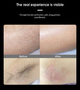 Máy Laser Ice Plus 3 Sóng Miễn Phí Vận Chuyển Laser Diode 808nm Tẩy Lông 808 755 1064 - Product Image 6