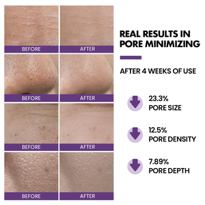 Özel gözenekler tedavi yüz Serum Anti Aging cilt bakımı serumu gözenek Minimizer gözenek küçülen Serum özel etiket - Product Image 5