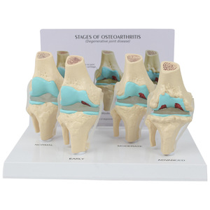 SCIEDU Teaching Resource Medical <strong>Human</strong> 4-stage Knee Joint Model with <strong>Back</strong> Card Diseased Knee Joint Model - Product Image 1