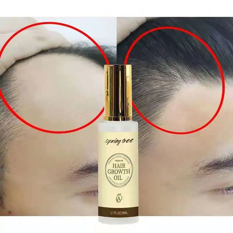 Etichetta privata ricrescita dei capelli trattamento di perdita dei capelli olio siero per la crescita dei capelli Aceites di zenzero naturale esenzione ciales Soin Cheveux per le donne