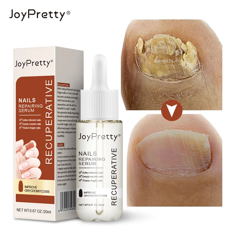 JoyPretty-suero para tratamiento de hongos en las uñas, Gel antihongos para el cuidado de los pies