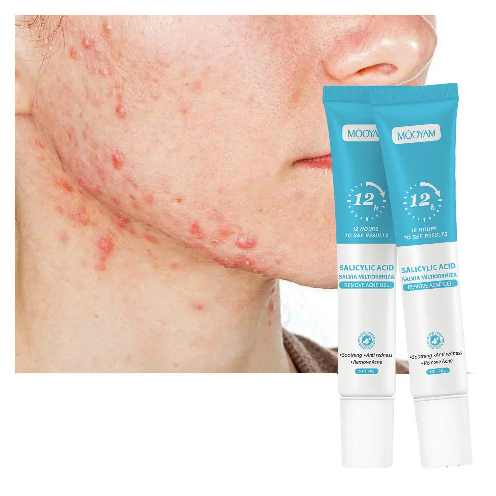 Gel de tratamento de acne para remoção de acne com ácido salicílico de marca própria, gel calmante anti-vermelho para rosto, remove acne