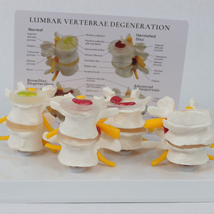 SCIEDU Teaching Resource Medical <strong>Human</strong> Skeleton Model Comparative Model of 4-stage Pathological Lumbar Spine with <strong>Back</strong> Card - Product Image 5