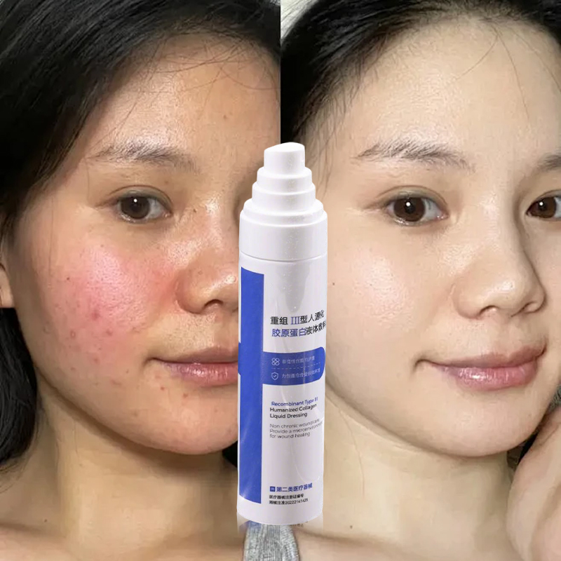Type III Humanized Collagen Medical Spray