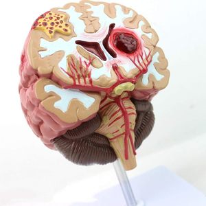 KyrenMed İnsan beyin patolojik Model malforme beyin hastalıklı yapı beyin epilepsi inme serebral vasküler hastalık modeli - Product Image 5