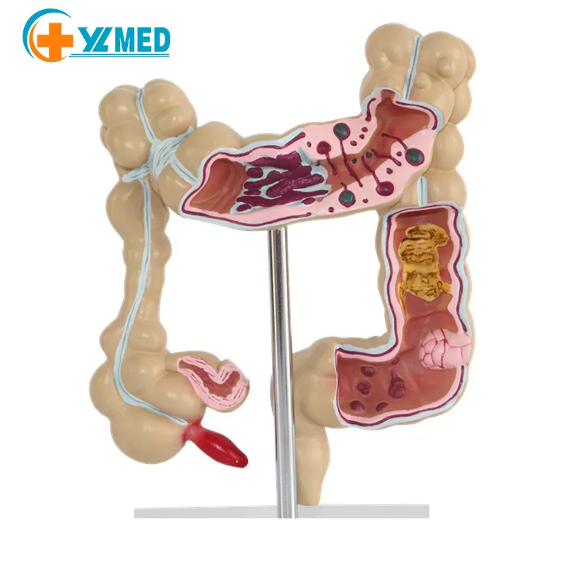 Modello di insegnamento medico anorettale comunicazione medico-paziente modello anatomico modello di intestino umano