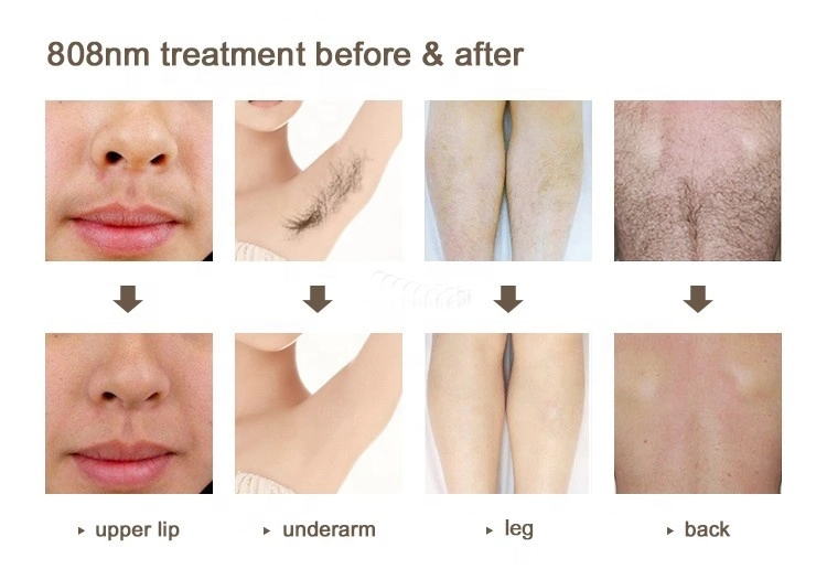 2 в 1 полупроводник + пикосекундный лазер(图1) 2 в 1 pico Laser de diodo 810nm alma laser harmony pro 755Nm 808Nm 1064Nm диодный лазер для удаления татуировок