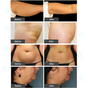 Machine multifonctionnelle de massage à rouleau RF sous vide pour la réduction de la cellulite et l'amincissement du corps par cavitation - Product Image 6