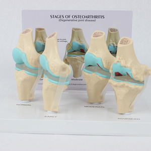 SCIEDU Teaching Resource Medical <strong>Human</strong> 4-stage Knee Joint Model with <strong>Back</strong> Card Diseased Knee Joint Model - Product Image 2