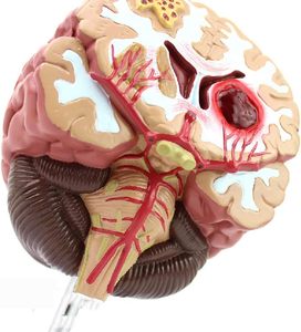 KyrenMed İnsan beyin patolojik Model malforme beyin hastalıklı yapı beyin epilepsi inme serebral vasküler hastalık modeli - Product Image 4