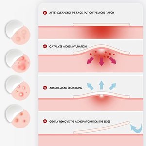 Hydrocolloid Teen Acneパッチを出荷する準備ができました36抗炎症およびにきび治癒のためのパッチ