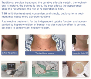 RFA Radiofrequency Tumor Ablation Generator Machine Therapy Minimally Invasive Rf <strong>Medical</strong> for Thyroid Nodules Rfa Needle - Product Image 3