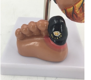 Medical Science <strong>Human</strong> Pathology Model Hypertension Anatomical Model High Blood Pressure Model - Product Image 6